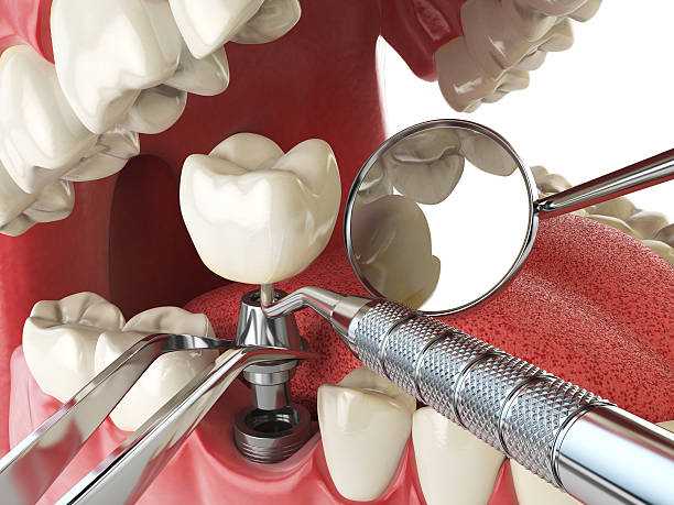 Best Emergency Treatment for Dental Infections or Abscesses in South Corning, NY